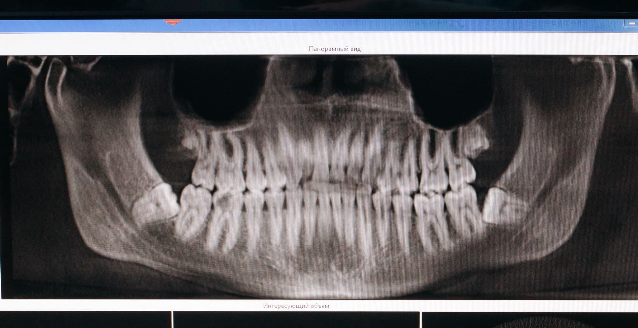 Greyscale panoramic dental radiograph of a full jaw filling a diagnostic monitor in dental imaging software